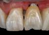 (50.) An opaqued titanium abutment was placed on the implant, and the natural tooth shell was then bonded to the abutment with flowable composite in the incisal half.