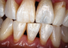 (57.) The provisional restoration was delivered and tightened to 15 Ncm while applying counter torque. Note that there is no pressure on the surrounding tissues and that the gingival embrasures were left open to allow for maximum incisal migration of the gingiva and papillae. The palatal and incisal surfaces were evaluated and modified to ensure that there was no contact throughout the excursive range.