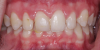 (1.) Pretreatment retracted view of a 16-year-old female patient who presented with generalized spacing between her maxillary anterior teeth. because she was still in her growth phase, milled composite veneers were planned as a transitional treatment. These would be replaced with definitive ceramic veneers once her growth phase was completed.