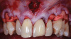 (4.) Example of the frenectomy anterior tunnel sulcular access channel approach, which combines envelope flaps with a vestibular access tunnel by incorporating the maxillary midline frenum.