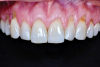 (6.) Preoperative retracted view of the generalized gingival recession in the maxilla extending from tooth No. 4 through tooth No. 13.