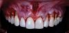 (7.) Intraoperative view of the maxillary arch after the frenectomy anterior tunnel sulcular access channel flap design was performed.