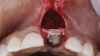 (6.) After the abutment and crown were recontoured, a soft-tissue graft was taken from the patient’s tuberosity and secured over the implant to add supracrestal volume, and the restoration was replaced. Note the planned position of the margin indicated in orange.