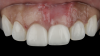 (9.) Postoperative photographs acquired after 2 weeks and 3 months of healing, respectively, demonstrating the reconstitution of an ideal tooth No. 9 marginal position in relation to its contralateral counterpart with increased soft-tissue thickness.