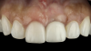 (10.) Postoperative photographs acquired after 2 weeks and 3 months of healing, respectively, demonstrating the reconstitution of an ideal tooth No. 9 marginal position in relation to its contralateral counterpart with increased soft-tissue thickness.