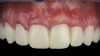 (19.) Four-month postoperative frontal and occlusal views revealing an ideal position of the tooth No. 9 margin in relation to its contralateral counterpart and an abundant amount of supracrestal soft tissue.