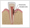 (3.) Vertical and horizontal cutaway views of an ECR lesion’s progression into a tooth’s structure. Note how its spread into the pulp is prevented by the PRRS.
