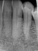 (7.) Radiographic presentation of ECR in tooth No. 22. Note the distal-cervical portal of entry and how the shape of the root canal is visibly distinct from the resorptive lesion.