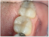 Fig 2. Restoration utlilizing 3M™ Filtek™ One Bulk Fill Restorative.