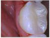 Fig 3b. A direct composite using Kerr SimpliShade Bulk Fill Packable.