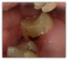 Fig 8a. A terminal abutment with proximal decay from a
removable cast metal partial denture. The composite used was
Tokuyama Omnichroma flow bulk.