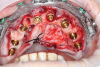 (22.) Full-arch treatment using a stackable surgical guide that employs components that attach to a foundation base, including views with the pin guide attached to the foundation base inserted over the existing dentition, the osteotomy guide attached and osteotomy being performed, the implants placed and the multi-unit abutments attached, and a prefabricated temporary prosthesis attached to the foundation base, ready to be luted to temporary cylinders for intraoral pickup, respectively.