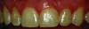 (3.) Posttreatment retracted close-up view of the tooth No. 10 veneer.