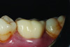 (6.) Posttreatment retracted close-up view of the restored tooth No. 19 (Case provided by class of 2024 dental student Forrest Fontenot, University of Alabama at Birmingham School of Dentistry.).