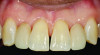 (9.) Postoperative retracted close-up view of the resin-bonded, single-wing cantilevered zirconia fixed partial dentures replacing teeth Nos. 7 and 10 (Case provided by class of 2024 dental student Maggie Bassey, University of Alabama at Birmingham School of Dentistry.).