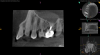 (1.) Preoperative CBCT scan showing Class 2 ECR defects on teeth Nos. 3 and 4 that were surgically accessible.