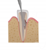 (8.) The defect is accessed through the pulp space and debrided with rotary or ultrasonic instruments.