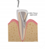 (10.) A 90% TCA solution is applied using a paper point.