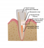 (11.) The portal of entry is sealed with bioceramic materials, endodontic obturation is completed with gutta percha and sealer, and the tooth is restored.