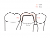 (1.) Illustration of a Class 0 interproximal relationship between a crown and the adjacent teeth. Both the mesial and distal aspects of the crown demonstrate adequate interproximal relief, permitting it to be passively seated.