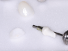 (3.) Extraoral view of a custom abutment for a cement-retained implant crown.