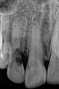 (1.) Pretreatment radiograph of tooth No. 7 showing an internal resorption lesion.