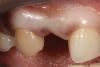 (2.) Close-up right lateral view of the tooth No. 7 site following extraction and implant placement.