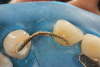 (4.) Occlusal view of a piece of retraction cord being used to measure the appropriate length of fiber reinforcement material required to ensure maximum bond strength. Note that the fiber extends two-thirds of the way across the occlusal surfaces of the abutment teeth.