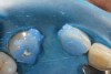 (6.) After being cleaned with a mixture of pumice and water and sandblasted, the bonding surfaces of the abutment teeth are etched with a 37% phosphoric acid etchant.