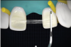 (7.) Digital graphic demonstrating how the main piece of fiber reinforcement material should be pressed against the palatal surface of the abutment teeth and then fanned out into the flowable resin to increase the surface area for greater retention.