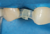 (8.) Close-up view after placement of the transverse vertical fiber for the pontic. Note how the main horizontal fiber was curved labially to provide space for the reinforcing transverse fiber to be attached to its palatal aspect with flowable composite.