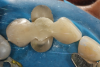 (11.) Occlusal view of the pontic being developed in the sectional matrix.