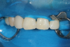 (12.) Final finishing and shaping of the bridge should be performed before removal of the rubber dam, but any final occlusal adjustments should be performed after.