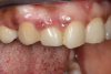 (14.) Three-month posttreatment close-up right lateral view of the final bridge. Note how the soft tissue at the site demonstrates adequate growth over the resin pontic, which will later translate into excellent esthetics for the implant-supported crown.