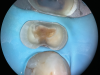 (3.) Close-up occlusal view of the maxillary first premolar after removal of the thin cusps and dissection of the mesial crack, which resulted in a subgingival margin.