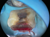 (8.) Close-up occlusal view of a maxillary first molar after the removal of deep subgingival caries, where despite rubber dam isolation, infiltration of blood and saliva into the cavity has occurred.
