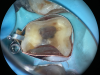 (9.) Close-up occlusal view of the maxillary first molar prepared for a matrix-in-matrix technique with a circumferential matrix supported by a 3-mil copper band inside for proper adaptation to the margin’s concave and convex areas. Note the addition of a liquid dam material placed between the two matrices for added stability.