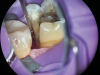 (11.) A Willems probe was used to determine that the depth of the margin was approximately 7 mm from the occlusal surface.