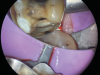 (12.) After subgingival placement of a Tofflemire matrix, despite using a wedge and adding additional support with polytetrafluoroethylene tape, fluid infiltration persists through the matrix and margin.