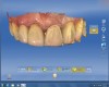 Figure 3 A copy line was drawn on the preoperative scan of tooth No. 9, which included the entire surface, line angles, and incisal edges.