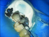 (5.) Intraoral images of a lower first molar before and after air abrasion to create a biobase. The accumulated aluminum oxide particles highlights the amount of abrasive used and the necessity of a rubber dam to prevent them from being inhaled or spread in the mouth.
