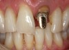 Figure 8 A patient presented with a fractured porcelain crown on tooth No. 9.