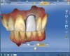 Figure 12 The software proposed a restoration of exactly the same form, shape, and size of tooth No. 8.