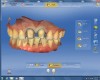 Figure 15 After scanning the “Buccal Bite,” the software compiled the three scans to mimic the patient’s maximum intercuspation.