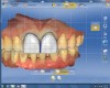 Figure 17 Several tools, including a grid to verify restoration symmetry, were utilized to modify the shape and form of the veneers.