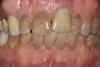 Figure 19 A patient presented with an uneven smile, discolored teeth, and insufficient tooth display when smiling.