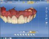 Figure 22 After cementation, the eight provisionalized teeth were scanned.