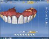 Figure 23 The crown designs were modified using different CAD software tools to create ideal embrasures, line angles, and contacts.