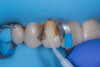 (10.) Application of adhesive onto the prepared tooth substrate prior to reattachment of the fractured ceramic fragment.