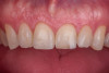 (15.) Intraoral view showing the fractured ceramic fragment positioned in place. The piece fits well, although minor gaps are present between the margins due to slight material loss, which can be restored using luting composite.